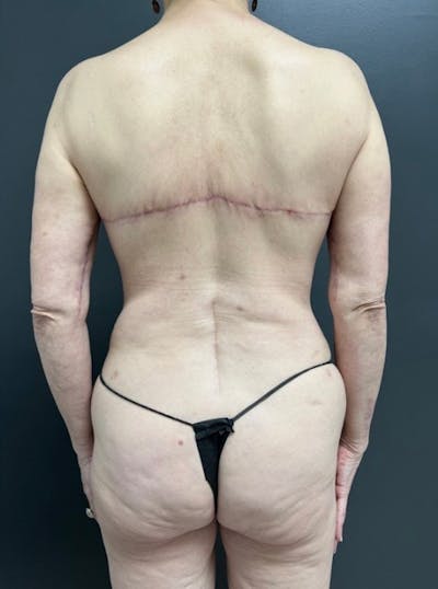 Back Lift Before & After Gallery - Patient 152617 - Image 2