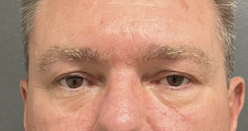 Blepharoplasty Before & After Gallery - Patient 160547 - Image 1