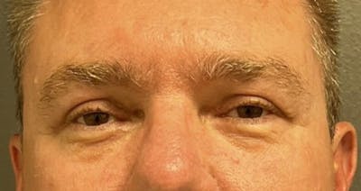 Blepharoplasty Before & After Gallery - Patient 160547 - Image 2