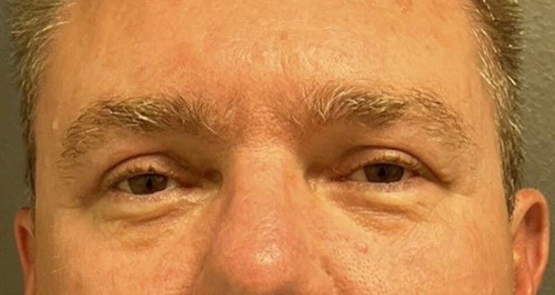 Blepharoplasty Before & After Gallery - Patient 160547 - Image 2
