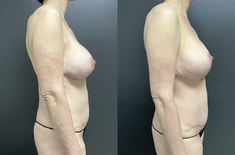 Abdomen Before & After Gallery - Patient 256282 - Image 3