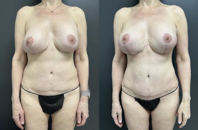 Abdomen Before & After Gallery - Patient 256282 - Image 1