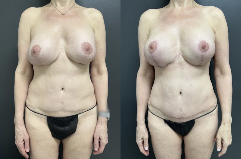 Abdomen Before & After Gallery - Patient 256282 - Image 1