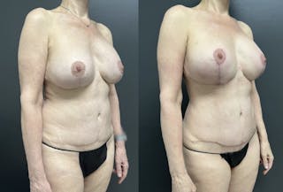 Abdomen Before & After Gallery - Patient 256282 - Image 2
