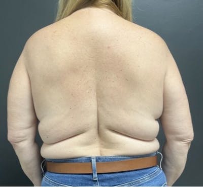 Back Lift Before & After Gallery - Patient 418885 - Image 1