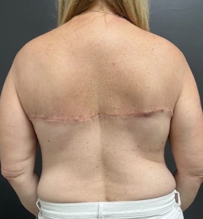 Back Lift Before & After Gallery - Patient 418885 - Image 2