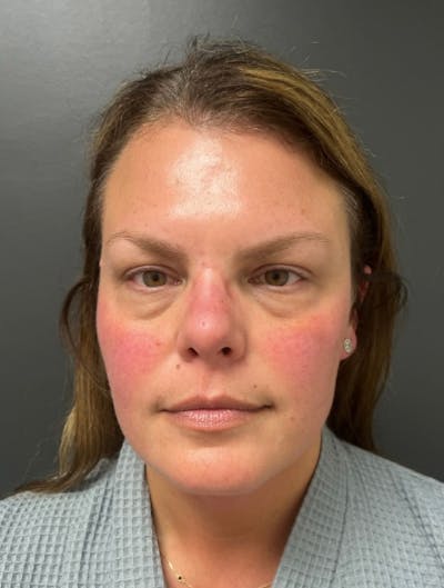 Facial Fat Grafting Before & After Gallery - Patient 599792 - Image 1