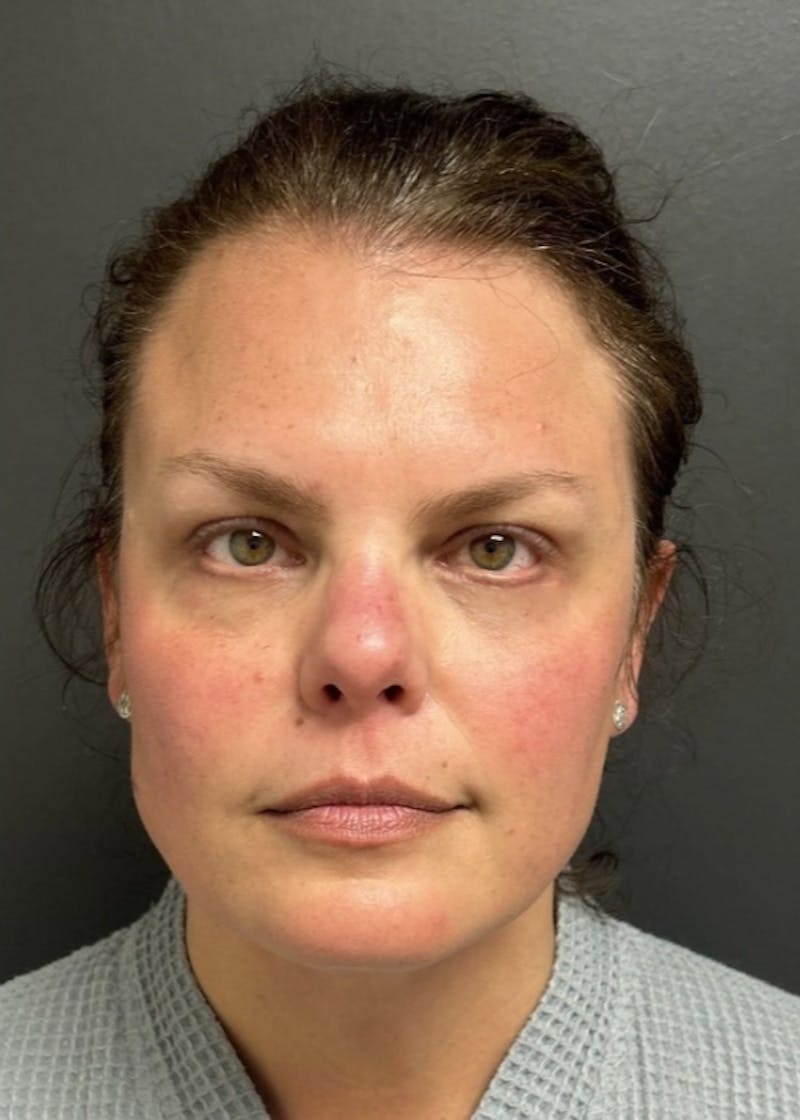 Facial Fat Grafting Before & After Gallery - Patient 599792 - Image 2