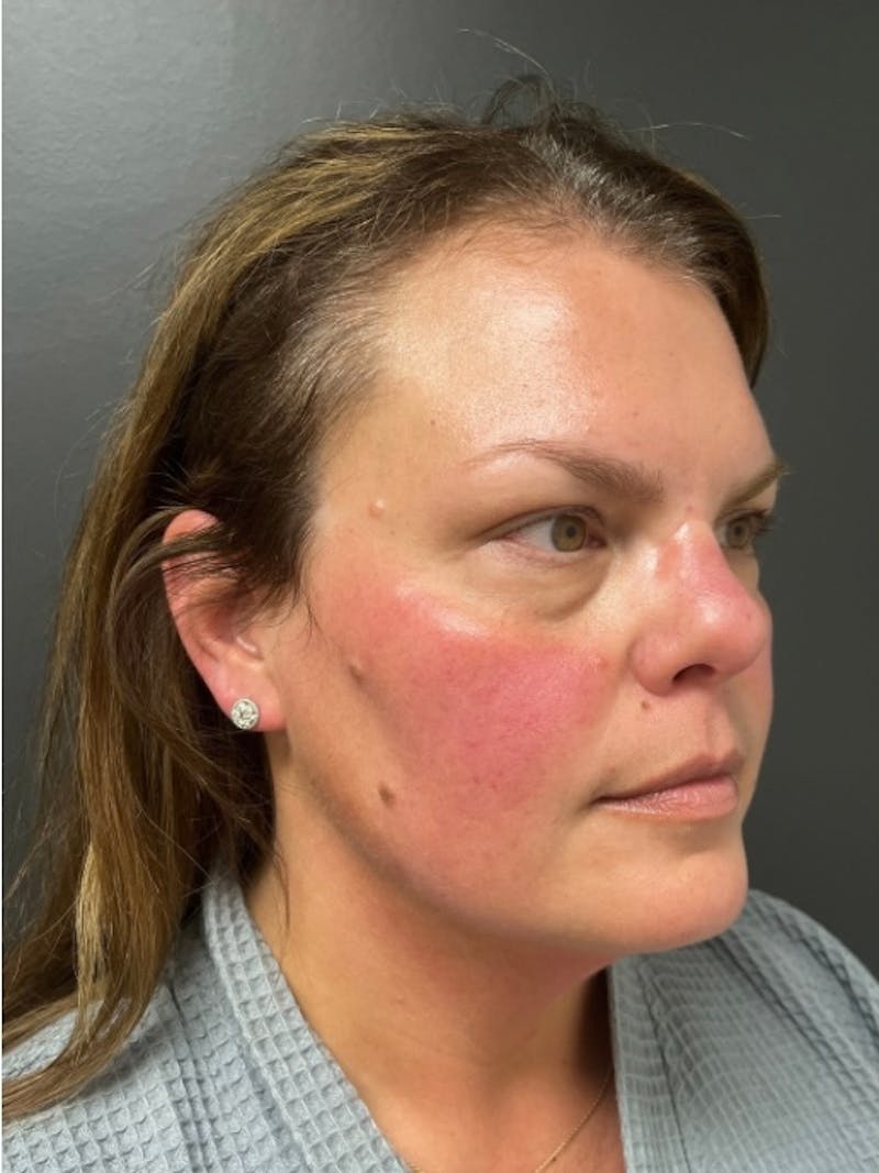 Facial Fat Grafting Before & After Gallery - Patient 599792 - Image 3