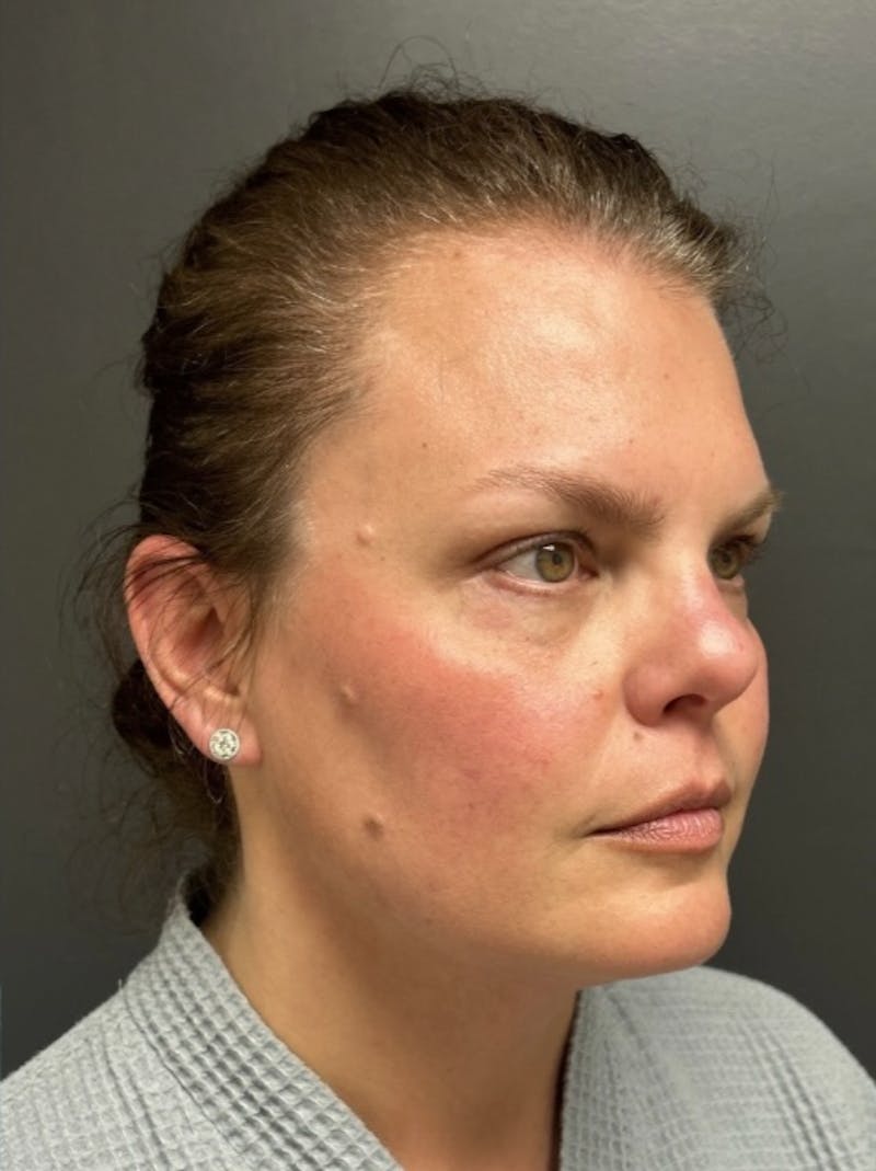 Facial Fat Grafting Before & After Gallery - Patient 599792 - Image 4