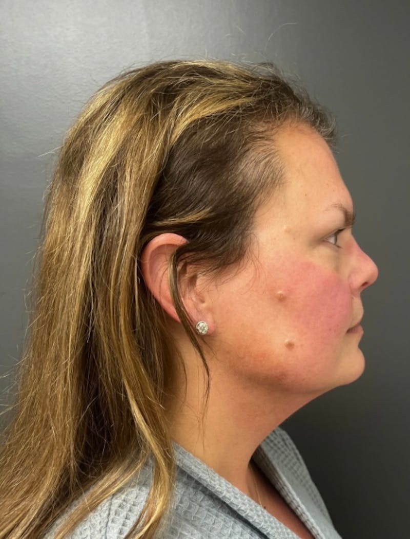 Facial Fat Grafting Before & After Gallery - Patient 599792 - Image 5