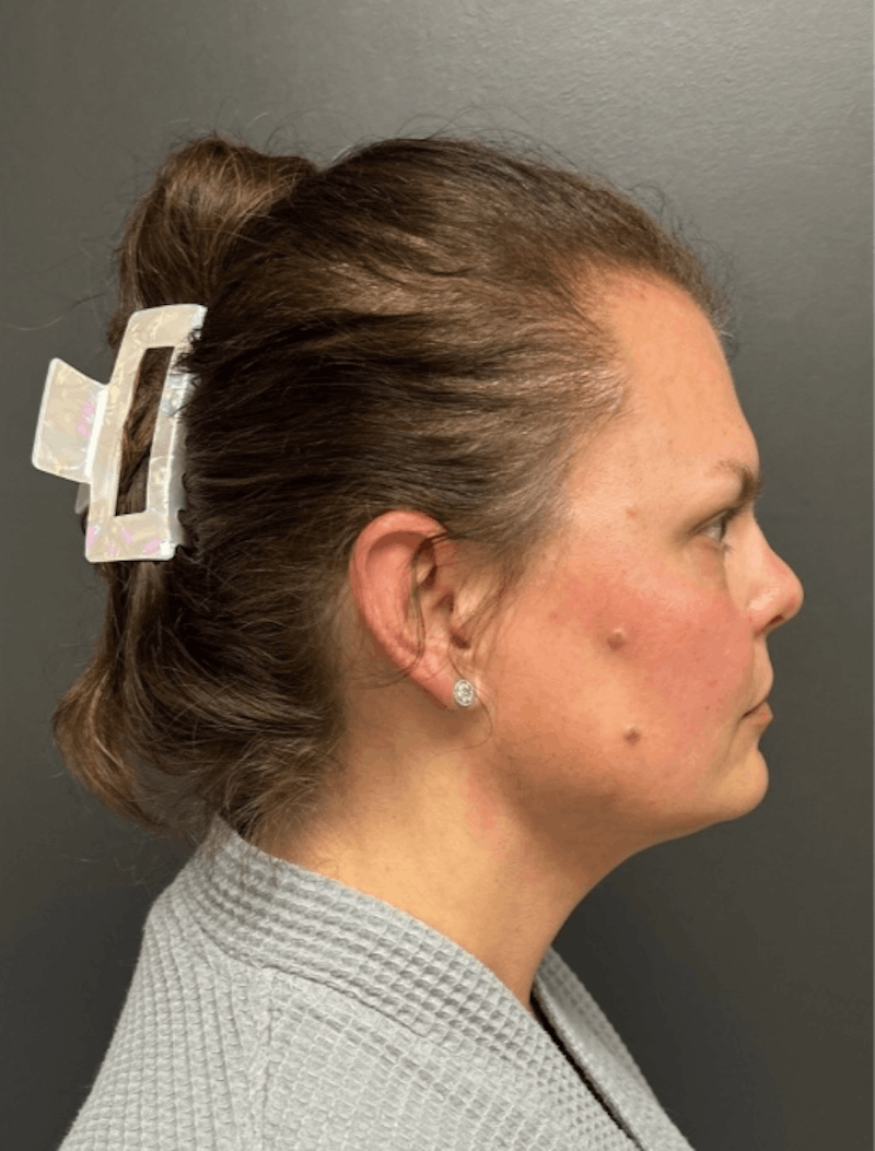 Facial Fat Grafting Before & After Gallery - Patient 599792 - Image 6