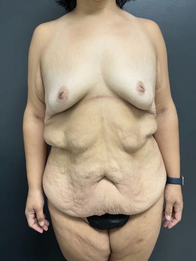 Fleur De Lis Abdominoplasty Before & After Gallery - Patient 124040 - Image 1