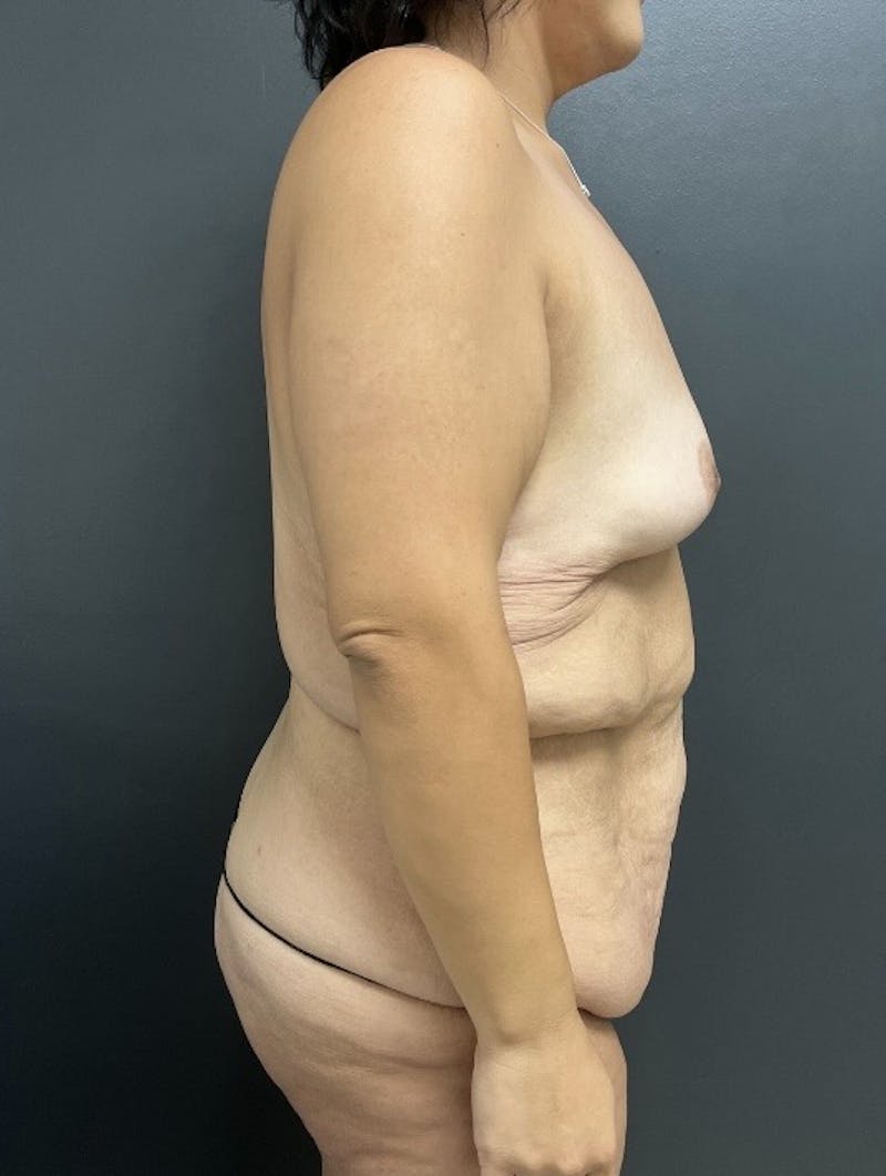 Fleur De Lis Abdominoplasty Before & After Gallery - Patient 124040 - Image 3