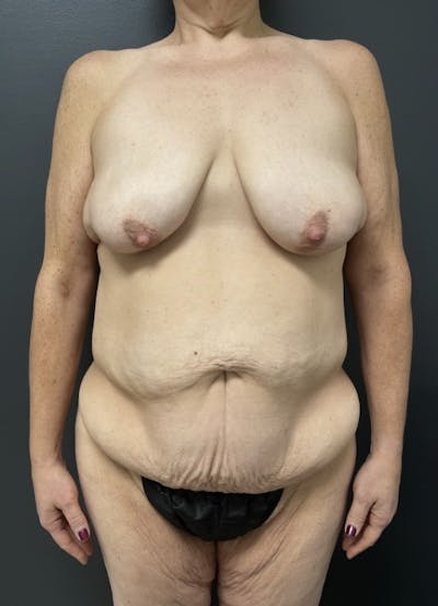 Fleur De Lis Abdominoplasty Before & After Gallery - Patient 175175 - Image 1