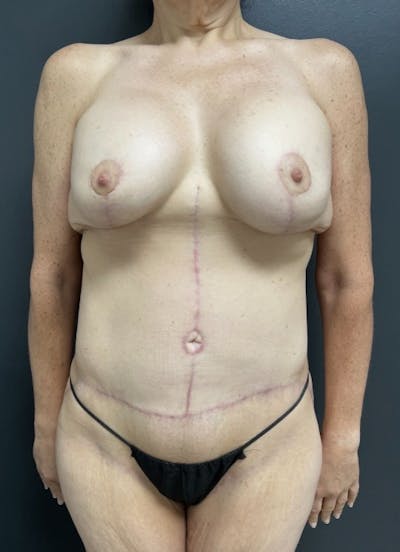Fleur De Lis Abdominoplasty Before & After Gallery - Patient 175175 - Image 2