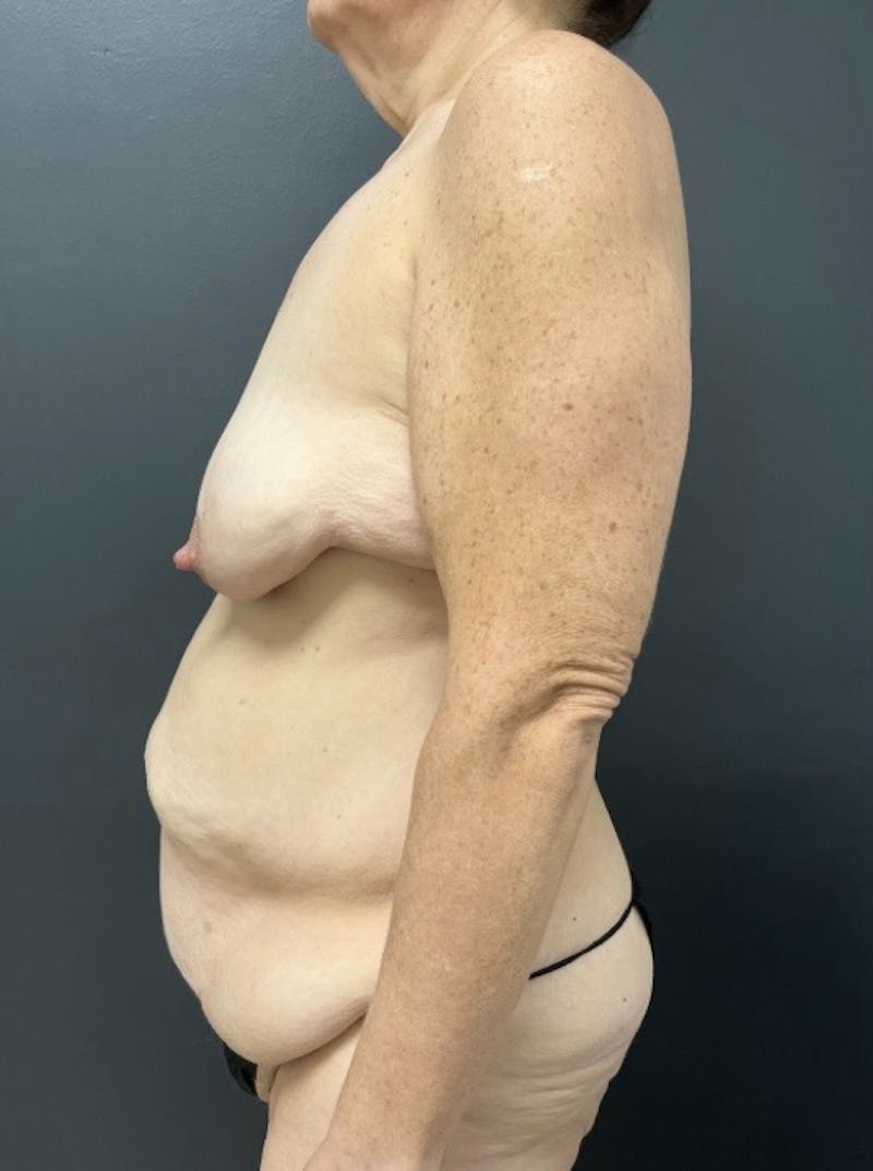 Fleur De Lis Abdominoplasty Before & After Gallery - Patient 175175 - Image 5