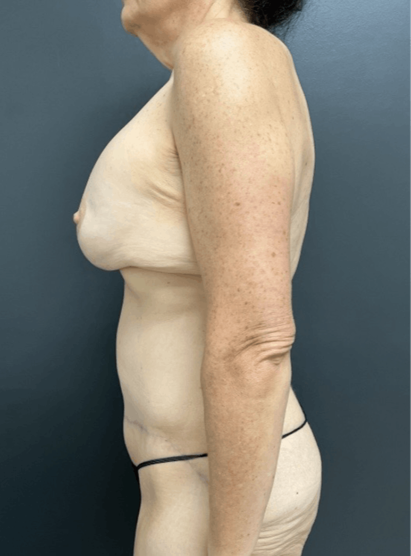 Fleur De Lis Abdominoplasty Before & After Gallery - Patient 175175 - Image 6
