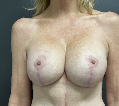Breast Augmentation with Lift Before & After Gallery - Patient 305182 - Image 2