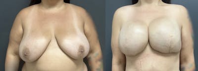 Breast Reconstruction Before & After Gallery - Patient 441881 - Image 1
