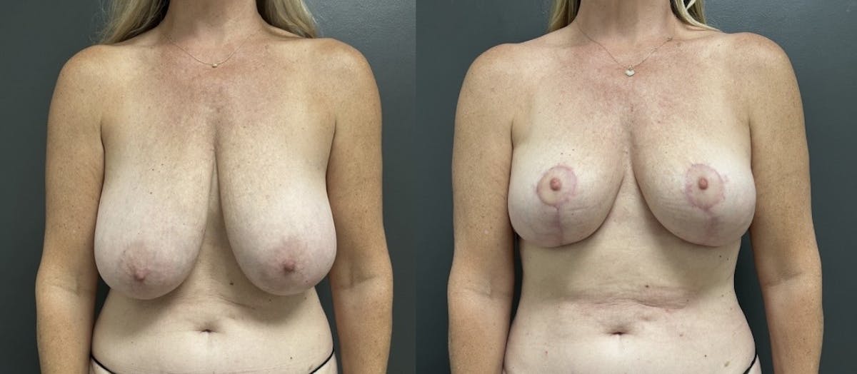 Breast Reduction Before & After Gallery - Patient 287803 - Image 1
