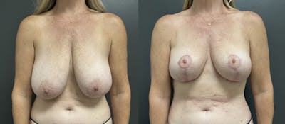 Breast Reduction Before & After Gallery - Patient 287803 - Image 1