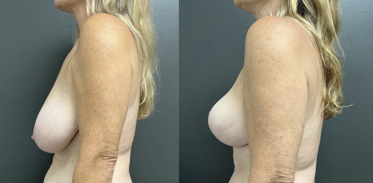 Breast Reduction Before & After Gallery - Patient 287803 - Image 2