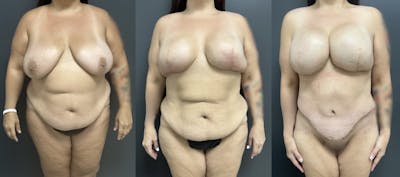 Abdominoplasty (Tummy Tuck) Before & After Gallery - Patient 274855 - Image 1