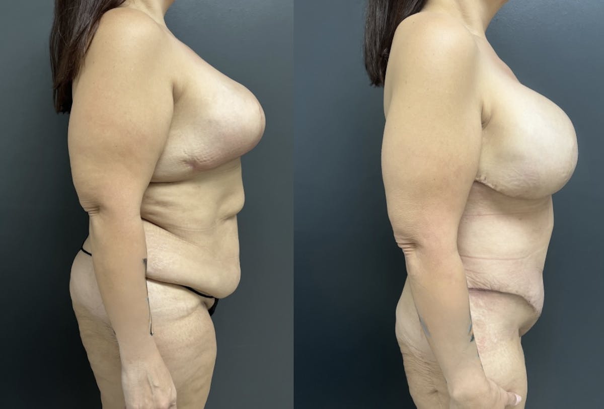 Abdominoplasty (Tummy Tuck) Before & After Gallery - Patient 274855 - Image 3