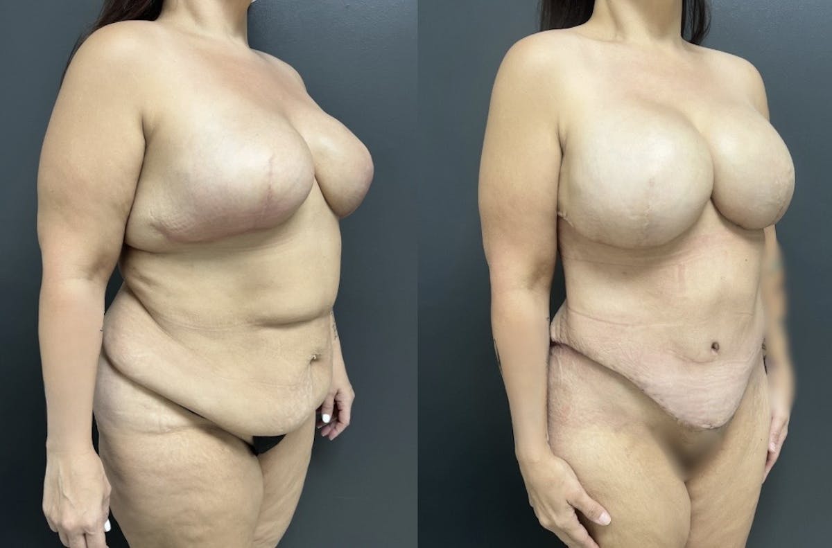 Abdominoplasty (Tummy Tuck) Before & After Gallery - Patient 274855 - Image 2