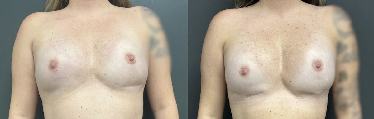 Breast Reconstruction Before & After Gallery - Patient 194356 - Image 1