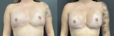 Breast Reconstruction Before & After Gallery - Patient 194356 - Image 1