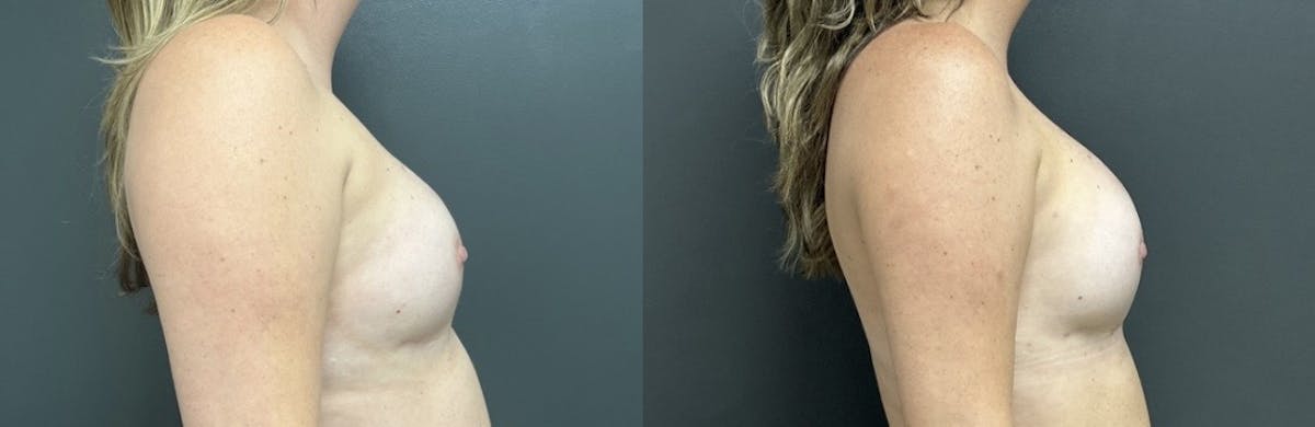 Breast Reconstruction Before & After Gallery - Patient 194356 - Image 3