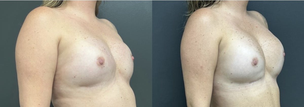 Breast Reconstruction Before & After Gallery - Patient 194356 - Image 2