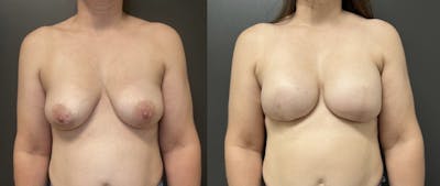 Breast Reconstruction Before & After Gallery - Patient 141886 - Image 1