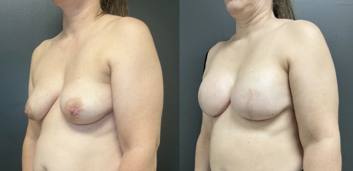 Breast Reconstruction Before & After Gallery - Patient 141886 - Image 2