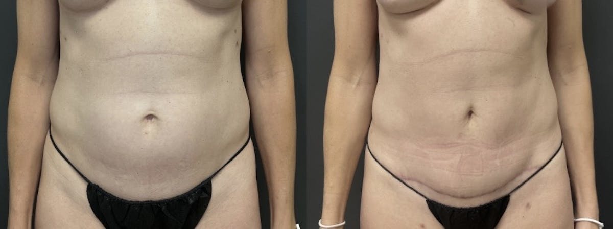 Mini Abdominoplasty Before & After Gallery - Patient 631101 - Image 1