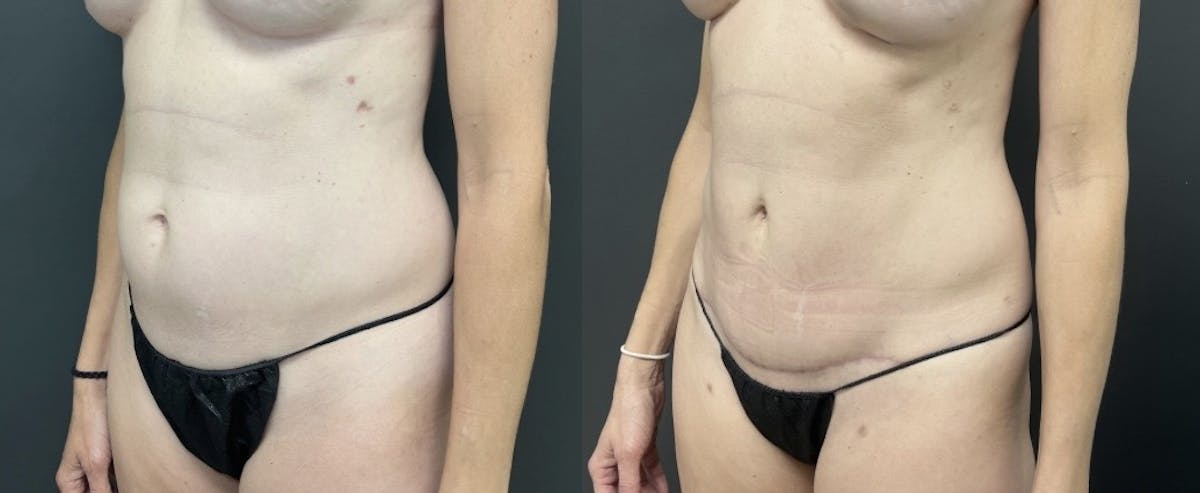 Mini Abdominoplasty Before & After Gallery - Patient 631101 - Image 2