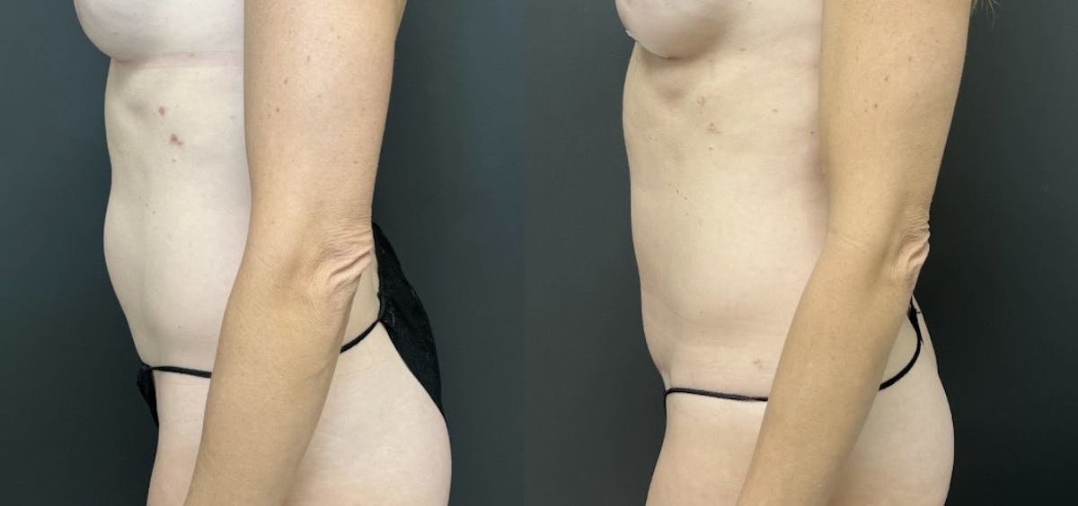Mini Abdominoplasty Before & After Gallery - Patient 631101 - Image 3
