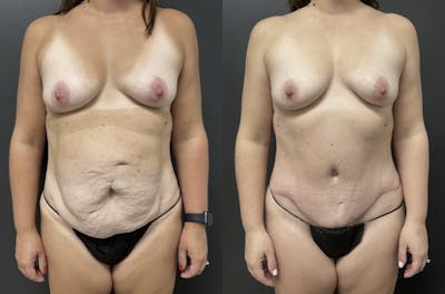 Abdominoplasty (Tummy Tuck) Before & After Gallery - Patient 269027 - Image 1