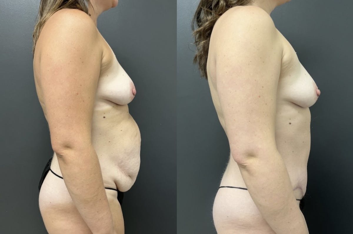 Abdominoplasty (Tummy Tuck) Before & After Gallery - Patient 269027 - Image 3