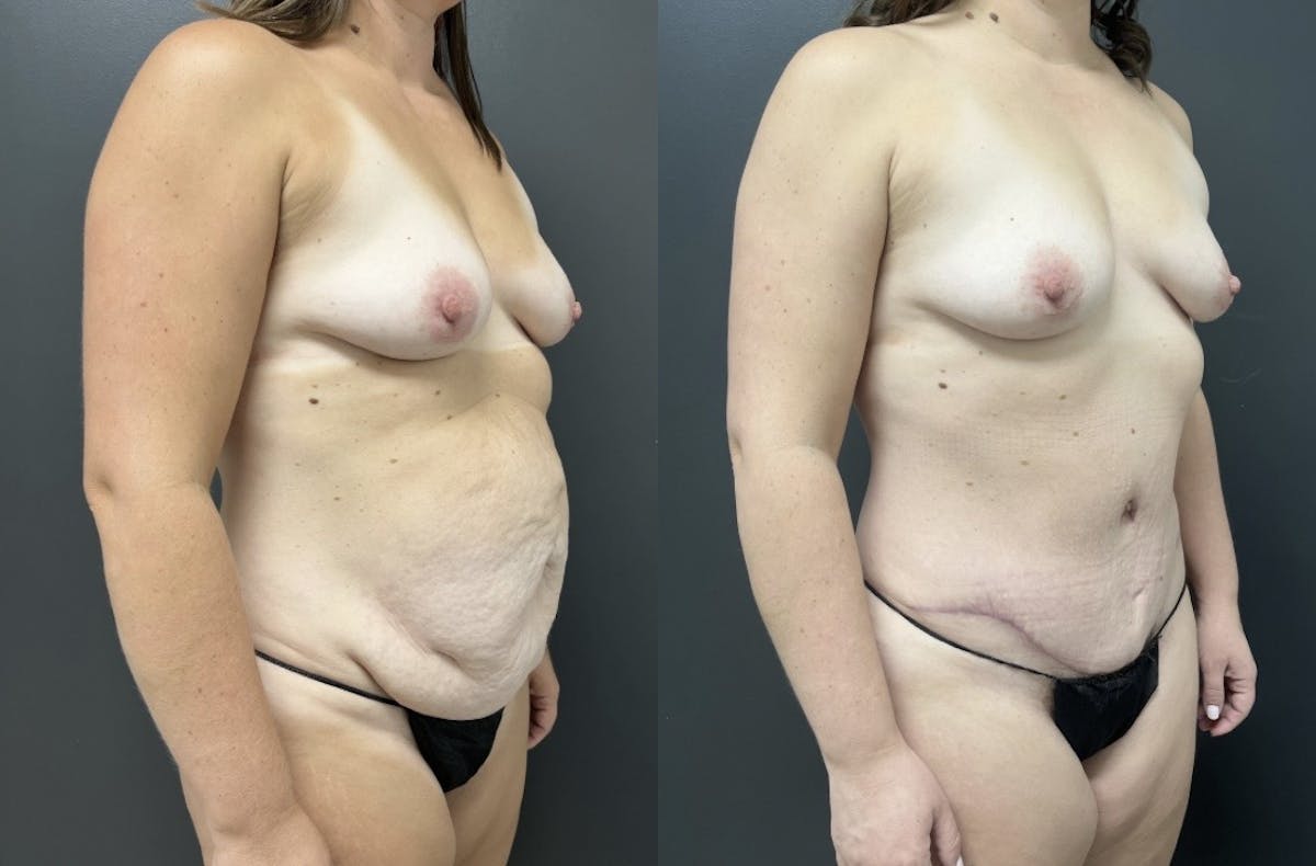 Abdominoplasty (Tummy Tuck) Before & After Gallery - Patient 269027 - Image 2