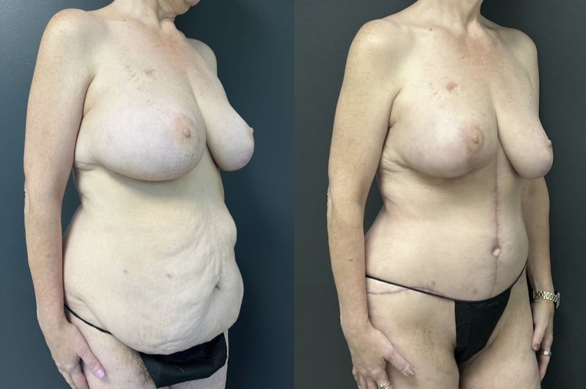 Fleur De Lis Abdominoplasty Before & After Gallery - Patient 346303 - Image 2