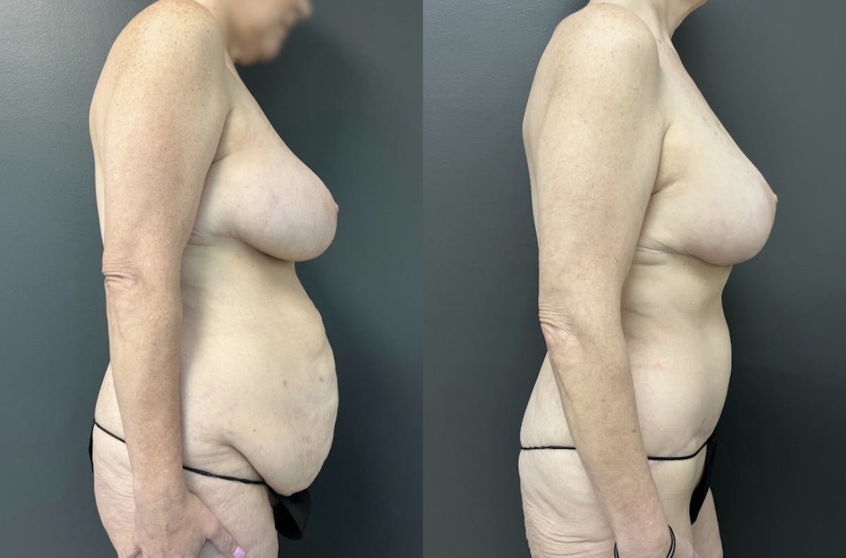 Fleur De Lis Abdominoplasty Before & After Gallery - Patient 346303 - Image 3