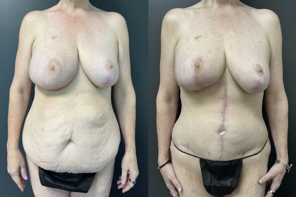 Fleur De Lis Abdominoplasty Before & After Gallery - Patient 346303 - Image 1
