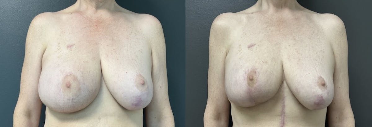 Breast Reconstruction Before & After Gallery - Patient 207176 - Image 1