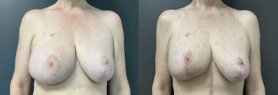 Breast Reconstruction Before & After Gallery - Patient 207176 - Image 1