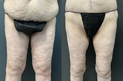 Thighplasty (Thigh Lift) Before & After Gallery - Patient 281256 - Image 1