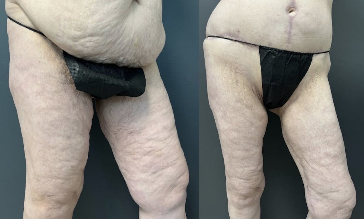 Thighplasty (Thigh Lift) Before & After Gallery - Patient 281256 - Image 2