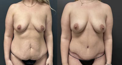 Abdominoplasty (Tummy Tuck) Before & After Gallery - Patient 231921 - Image 1